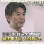 俺の髪の毛が帰ってきた？最新の毛髪再生医療ｗｗｗ
